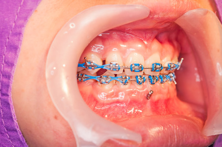 Close-up orthodontics braces with miniscrew の写真素材