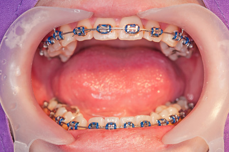 Close-up Orthodontic braces with o-ringの写真素材