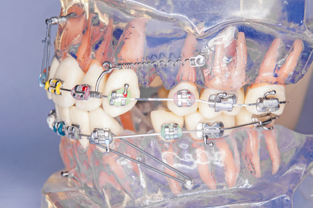 Braces model with miniscrewの写真素材