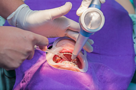 An extreme close-up of a dental patient having her teeth cleaned and polished by the dentist with dental assistant の写真素材