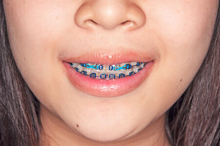 Close-up of a happy teenage girl smiling with bracesの写真素材