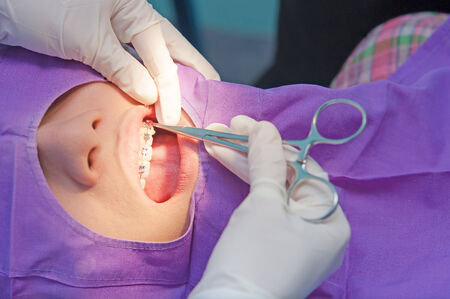 Teenage girl with the braces on her teeth is having a treatment at dentistの写真素材