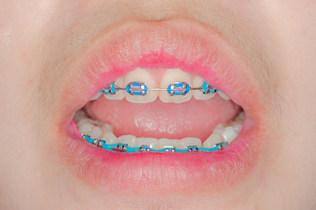 Closeup on braces and white teeth of smiling girlの写真素材