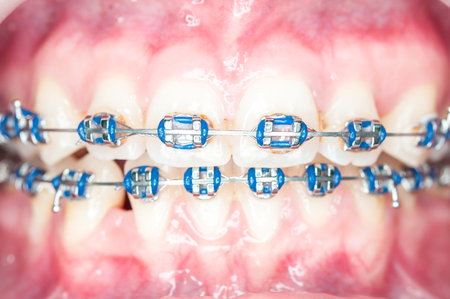 Close-up orthodontics teeth with stains.