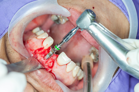 Dental implants surgery in real patientの写真素材