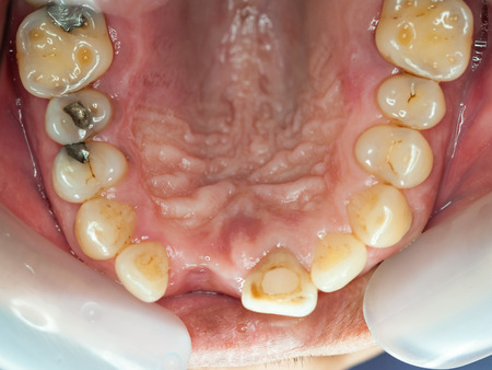 Dental implants surgery in real patientの写真素材