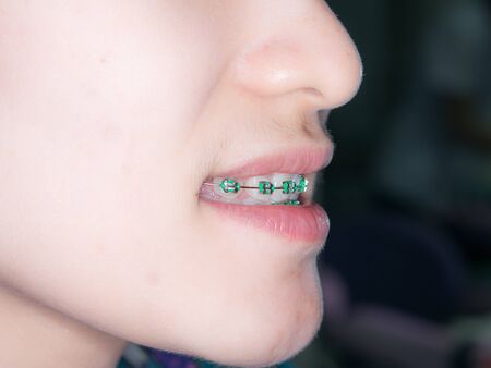 Close Up on braces and white teeth of smiling girl