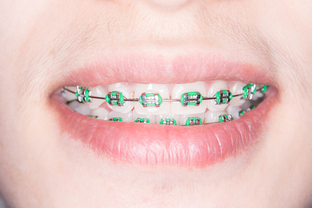 Close Up on braces and white teeth of smiling girlの写真素材