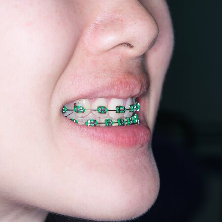 Close Up on braces and white teeth of smiling girlの写真素材