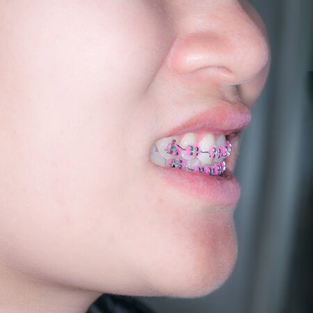 Close Up on braces and white teeth of smiling girl