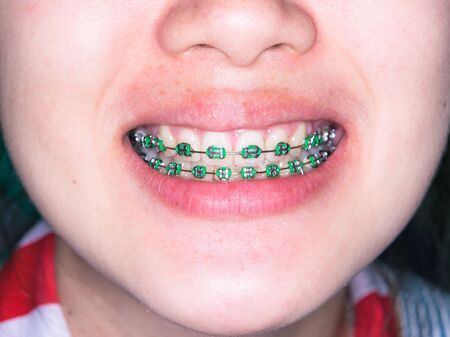 Close Up on braces and white teeth of smiling girl