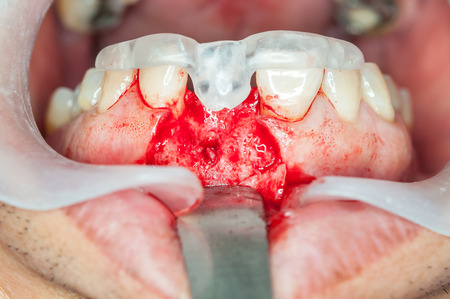 Dental implants surgery in real patientの写真素材