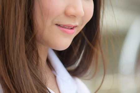 braces and white teeth of smiling girl