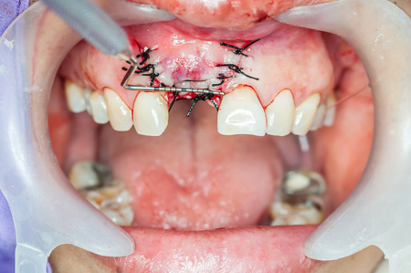 Dental implants surgery in real patientの写真素材
