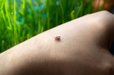 Infected dangerous tick on human skin - a carrier of infections and viruses. Parasitic mite. Ixodus...