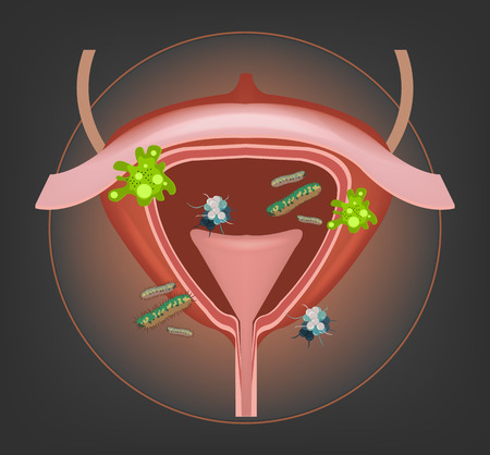 Human bladder with bacteria and germs. Vector illustrationのイラスト素材