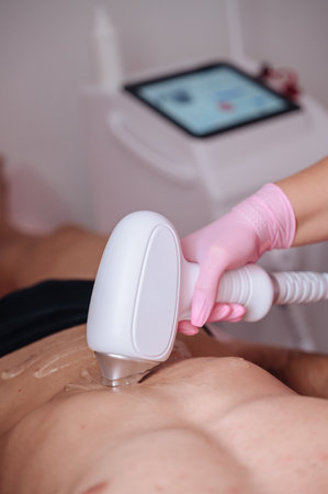 Female specialist performing laser hair removal on male client, salon procedure.の写真素材