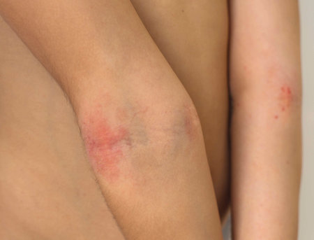 child shows her combed dry skin on the bend of her elbow, redness, roughness, itching from atopic...