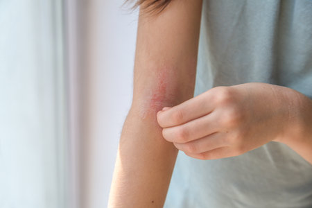 a girl scratches the skin on the elbow of her arm, redness is atopic dermatitis, the girlâ€™s...