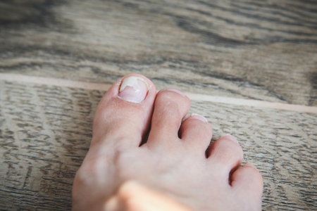 Closeup of foot with peeling and damaged toenail on big toe over wooden floor, concept of personal...