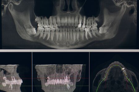 X-ray of the jaw in the dental clinic.の写真素材