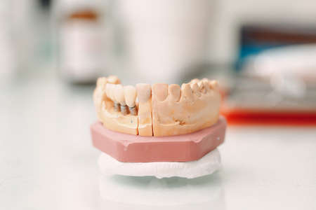 Dental layout of the human jaw with teeth and implants.の写真素材