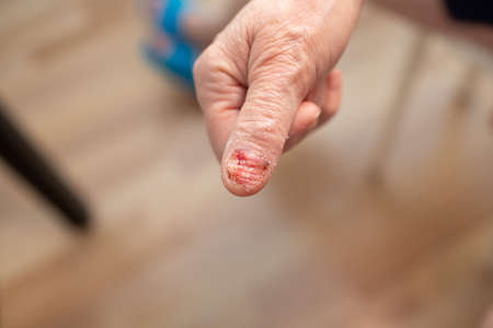 Felon whitlow on hand finger toe injured to lose nail