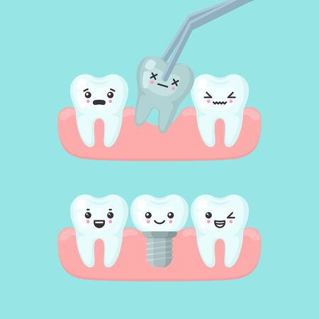 Tooth extraction and implantation stomatology concept. Cute cartoon vector teeth implant isolated illustrationのイラスト素材