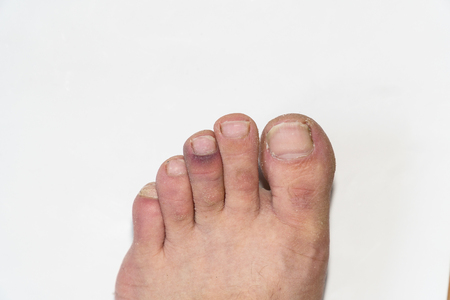 The bruise on the toe. Isolated on white backgroundの写真素材