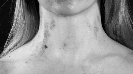 Womens neck: traces of violence. Black and white photoの写真素材