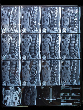 column lumbosacral MRI, sagittal and axial. Highlight herniated disc in L5-S1