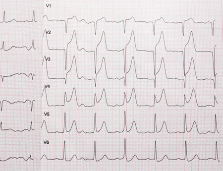 Tape ECG with Acute anterior wall myocardial infarction.の写真素材