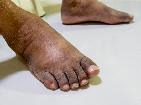 The feet of people with diabetes, dull and swollen. Due to the toxicity of diabetes.の写真素材