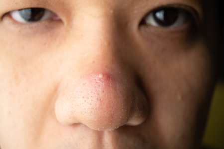 Closed-up many blackhead pimples and acne scars on the nose of an Asian skin faceの写真素材