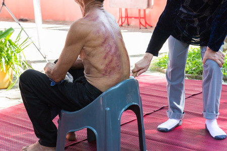 Chiangmai, Thailand - November 8, 2014: The teacher demonstrate guasa technique which is the Alternative medicine for skin detoxifying on man's backのeditorial素材