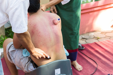 Chiangmai, Thailand - November 8, 2014: The teacher demonstrate guasa and skin vacuum technique which is the Alternative medicine for skin detoxifying on man's backのeditorial素材
