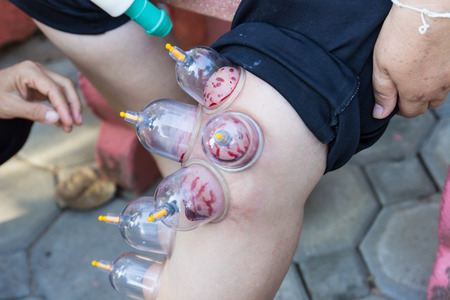 Chiangmai, Thailand - November 9, 2014: leg skin cupping vacuum and Phlebotomy, the chinese alternative medicine for detoxifyingのeditorial素材