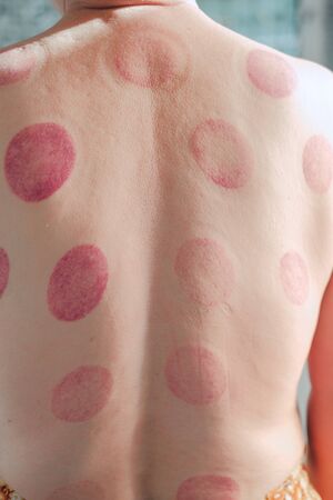 red blood patch mark on back after chinese cupping massage treatment therapyの写真素材