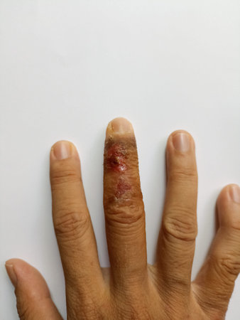 rash eczema dermatitis  on hand. inflammation of skin