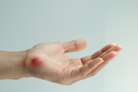 scratch wound on female hand closeup, healthcare and medicine conceptの写真素材