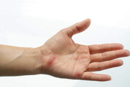 scratch wound on female hand closeup, healthcare and medicine conceptの写真素材