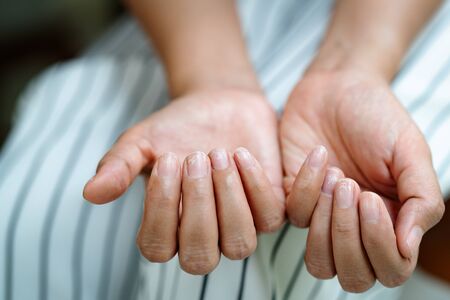 brittle damaged nails after using shellac or gel-lacquerの写真素材