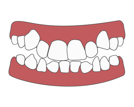 Orthodontic teeth crowding. abnormal eruption. Opposite occlusion, open bite, crowded teeth, cavities, dentition. Vector illustration isolatedのイラスト素材