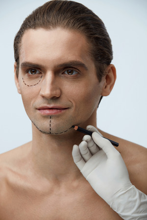 Facial Beauty Operation. Portrait Of Handsome Man With Black Lines Before Plastic Surgery. Closeup Of Hand With Pencil Drawing Line On Attractive Male Face. Cosmetology And Beauty. High Resolutionの写真素材