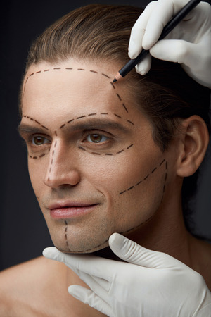 Cosmetology. Portrait Of Handsome Young Man With Black Lines On Facial Skin. Closeup Of Hands Drawing Surgical Line On Attractive Male Face Before Beauty Operation. Plastic Surgery. High Resolutionの写真素材