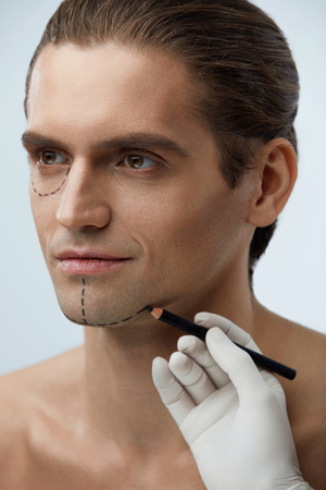Facial Beauty Operation. Portrait Of Handsome Man With Black Lines Before Plastic Surgery. Closeup Of Hand With Pencil Drawing Line On Attractive Male Face. Cosmetology And Beauty. High Resolutionの写真素材
