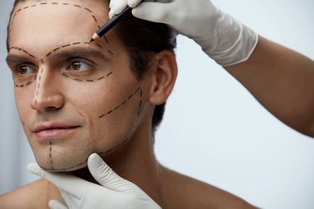 Male Plastic Surgery. Closeup Of Handsome Man With Beautiful Face And Black Lines On Skin Before Beauty Operation. Man's Face And Hands Drawing Marks With Pencil On It. Cosmetology. High Resolutionの写真素材