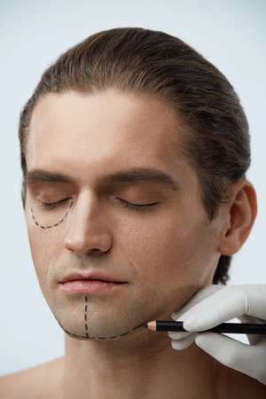 Plastic Surgery. Portrait Of Beautiful Male Face With Black Pencil Lines On Skin. Closeup Of Doctor's Hand Applying Cutting Line On Skin Before Facial Beauty Operation. Cosmetology. High Resolutionの写真素材