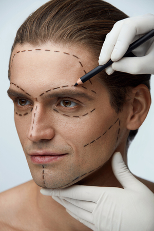 Male Plastic Surgery. Closeup Of Handsome Man With Beautiful Face And Black Lines On Skin Before Beauty Operation. Man's Face And Hands Drawing Marks With Pencil On It. Cosmetology. High Resolutionの写真素材