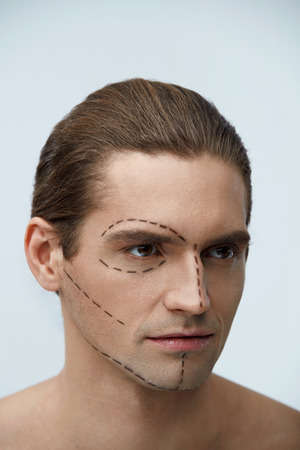 Plastic Surgery. Portrait Of Handsome Man With Surgical Black Lines On Beautiful Face Before Skin Lifting Operation. Closeup Of Attractive Young Male Before Beauty Facial Treatment. High Resolutionの写真素材
